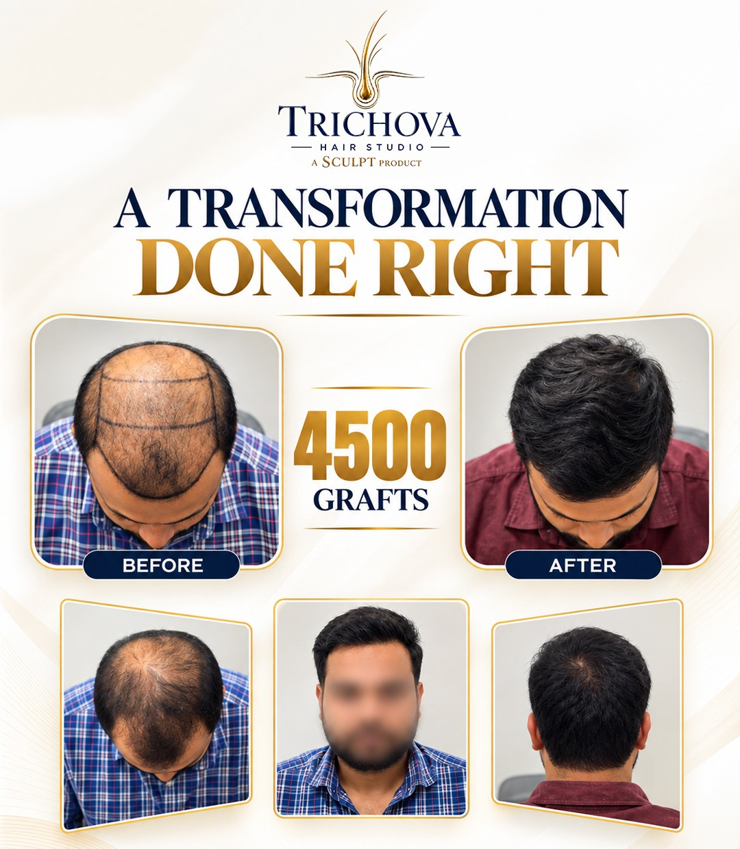 4500 Grafts Restoration