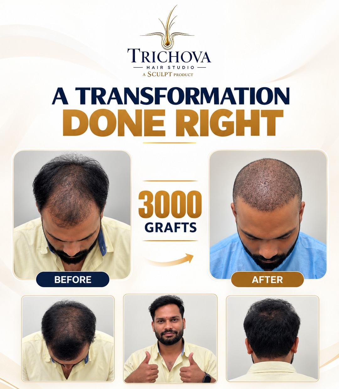 3000 Grafts Restoration