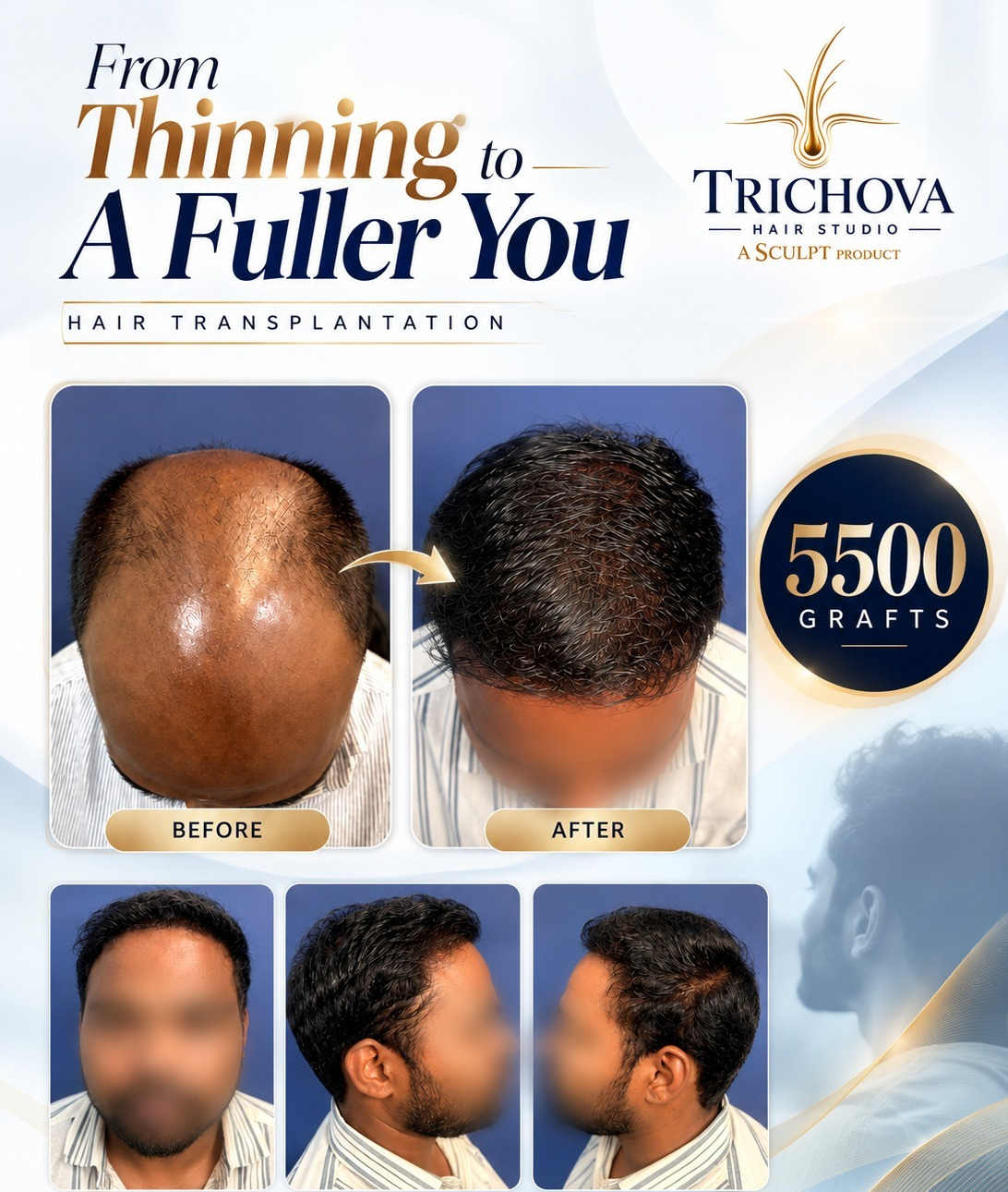 5500 Grafts Restoration